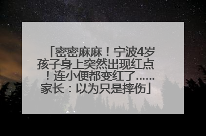 密密麻麻！宁波4岁孩子身上突然出现红点！连小便都变红了……家长：以为只是摔伤